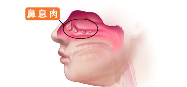 鼻息肉2.png